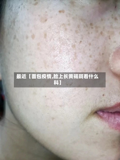 最近【面包疫情,脸上长黄褐斑看什么科】-第1张图片
