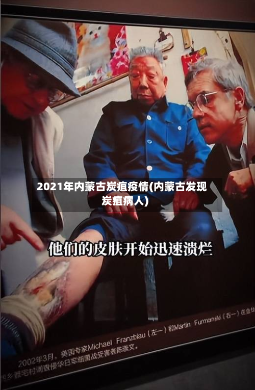 2021年内蒙古炭疽疫情(内蒙古发现炭疽病人)-第1张图片